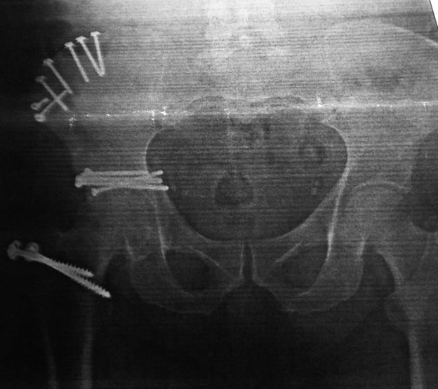 Hip Injury Xray